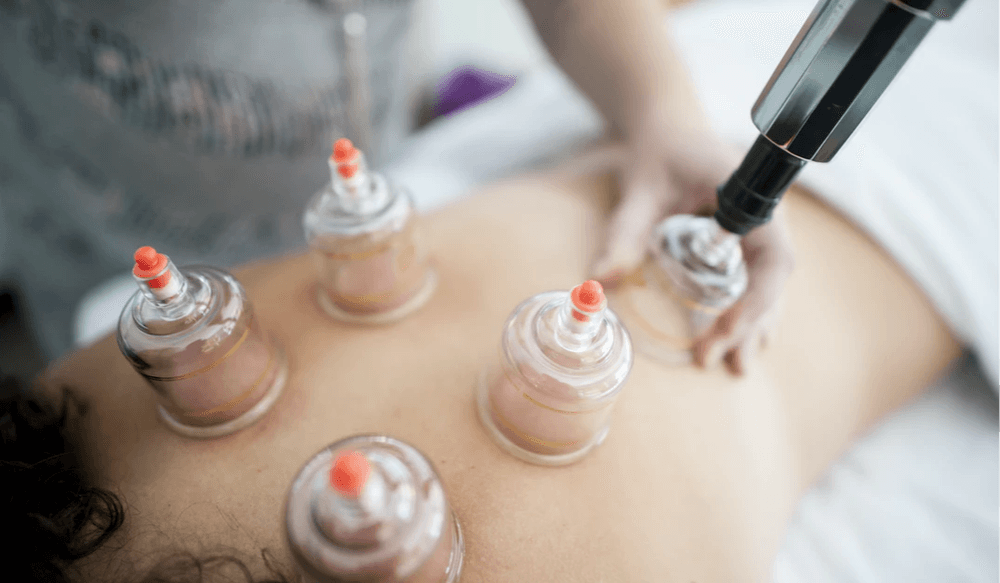 Cupping